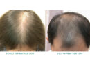 hair loss specialist