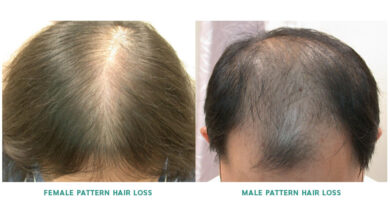 hair loss specialist